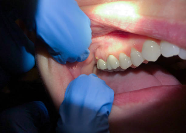 Teeth Whitening in MI